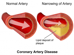 enfermedad de las arterias y diabetes